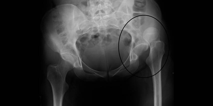 Who (and Why) Risks Dislocation After Hip Arthroplasty?