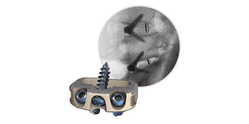 Study: Stand-Alone STALIF M Is a ‘Reasonable Alternative’