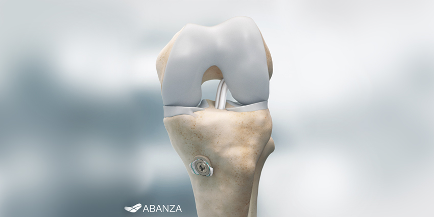 FDA Clears ACL Reconstruction Soft-tissue Fixation System