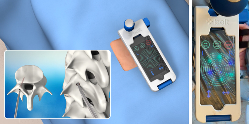 Hand-held Spine Surgery Navigation Device Gets 510(k) Clearance