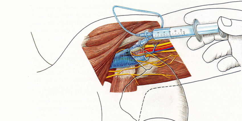 Modified Anesthesia for Elderly Hip Fractures?