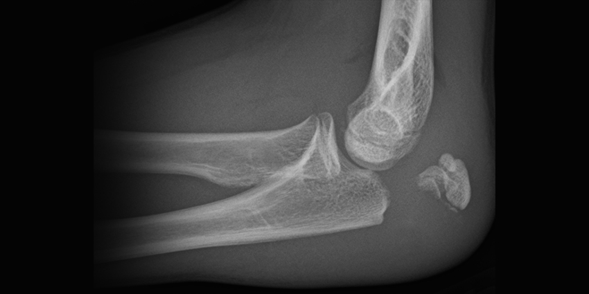 Elbow Fractures: Surgery or Not?