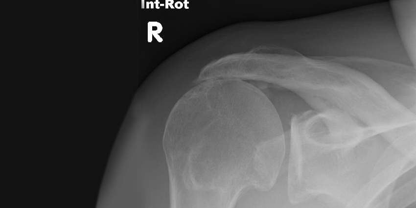 Do Umbilical Cord Stromal Cells Aid in Rotator Cuff Healing?