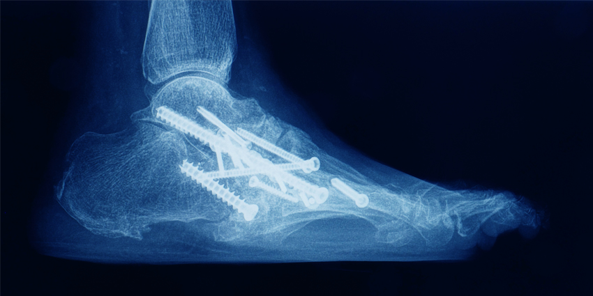 Arthroscopic Ankle Arthrodesis Superior to Open Ankle Arthrodesis