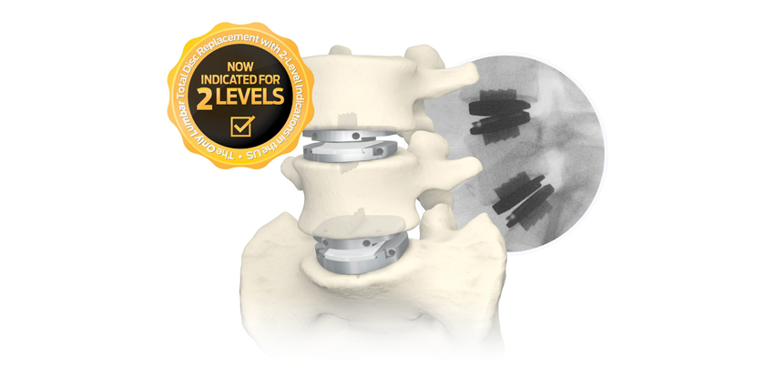 NEW CPT Add-On Code for Two-Level Lumbar TDR