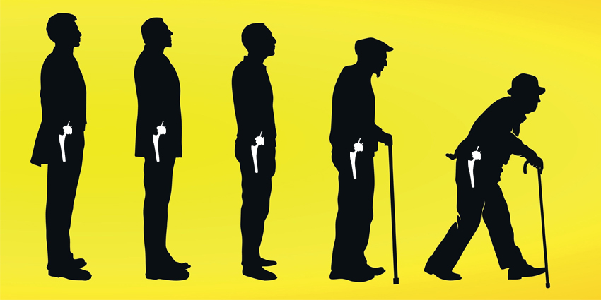 30-Year (!) Cemented vs Cementless Hip Implant Survivorship Data