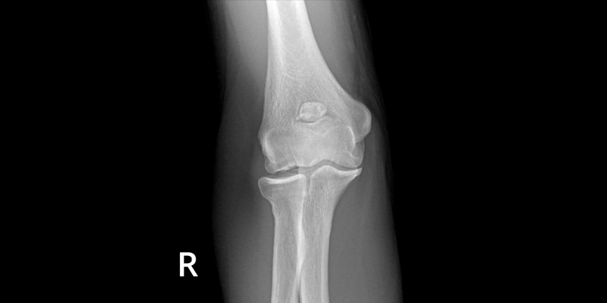 Debridement Not Recommended for Elbow OCD Lesions