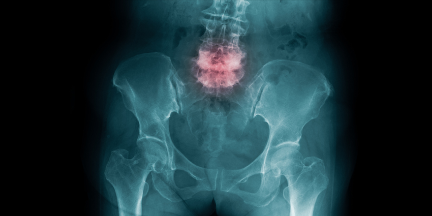 Updated Spine Fracture Practice Guidelines Released