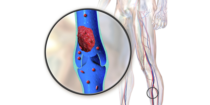 Does Aspirin After Meniscus Root Repair Elevate DVT Risk?