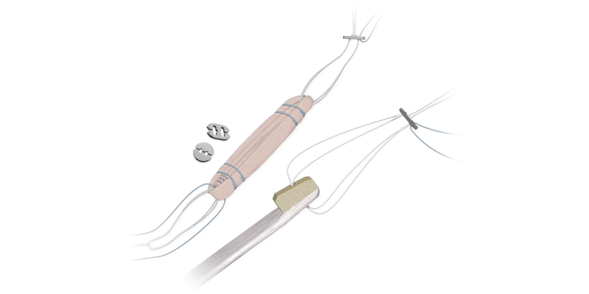 FDA Clears Device for ACL Reconstruction in Children