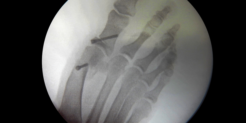 Lower Fusion Rate With Arthrodesis for Bunions