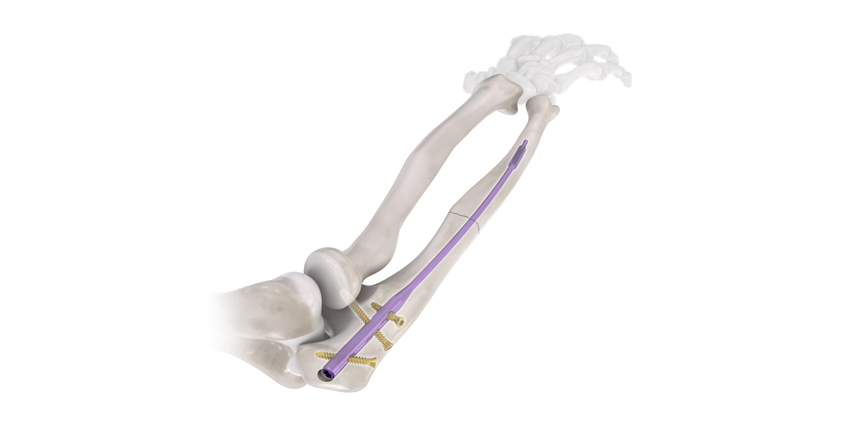 Ulna Intramedullary Nail System Gets 510(k) Clearance