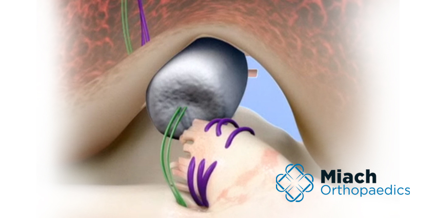 Miach Orthopaedics Raises $40M
