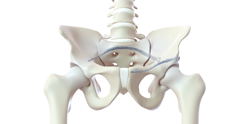 New Option for Fragility Fractures With 7.5mm CurvaFix IM
