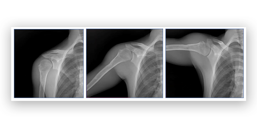 Dynamic Digital Radiography Better for Shoulder Injuries