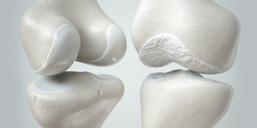 ‘Longevity Protein’ Key to Knee Cartilage Health?