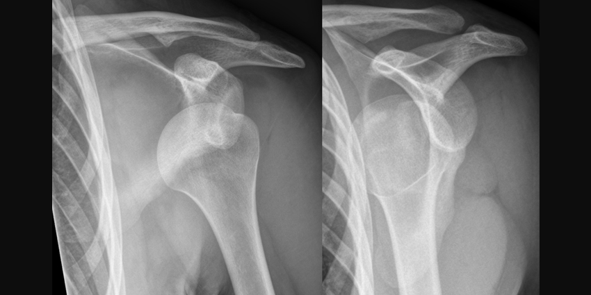 Less Instability After Arthroscopic Stabilization of Shoulder