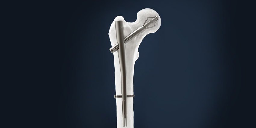 510(k) Clearance for Femur Fracture Fixation Nailing System