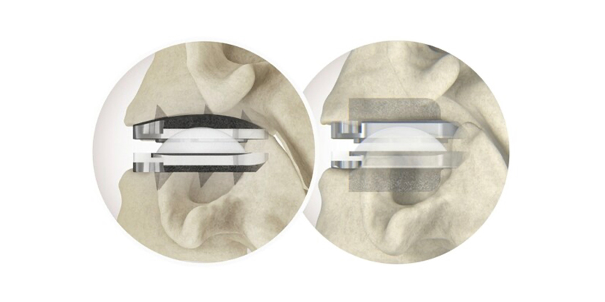 prodisc Cervical Hits 500th Procedure Milestone