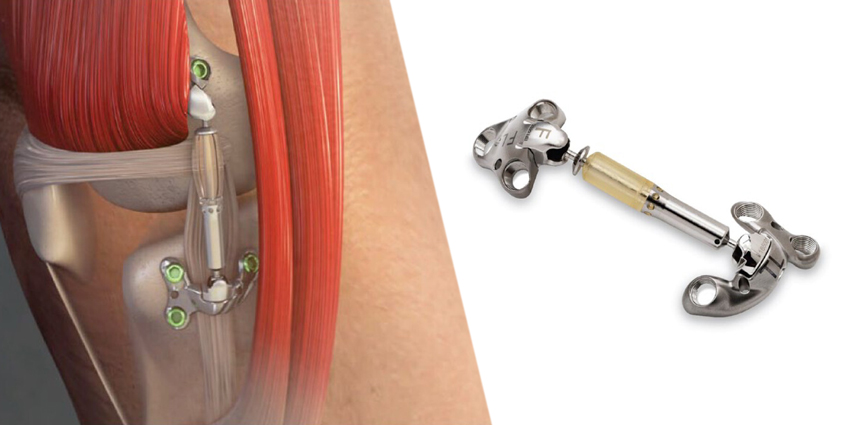 Implantable Knee Shock Absorber: 2-Year Outcomes