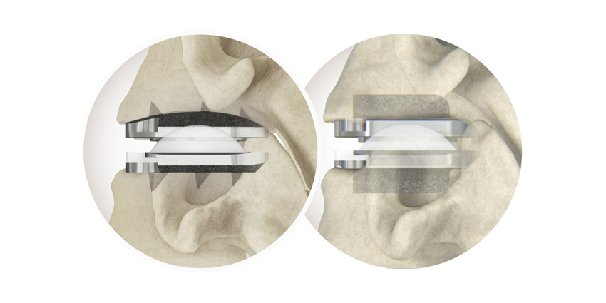 Centinel Spine Doubles Cervical TDR Sales in 60 Days