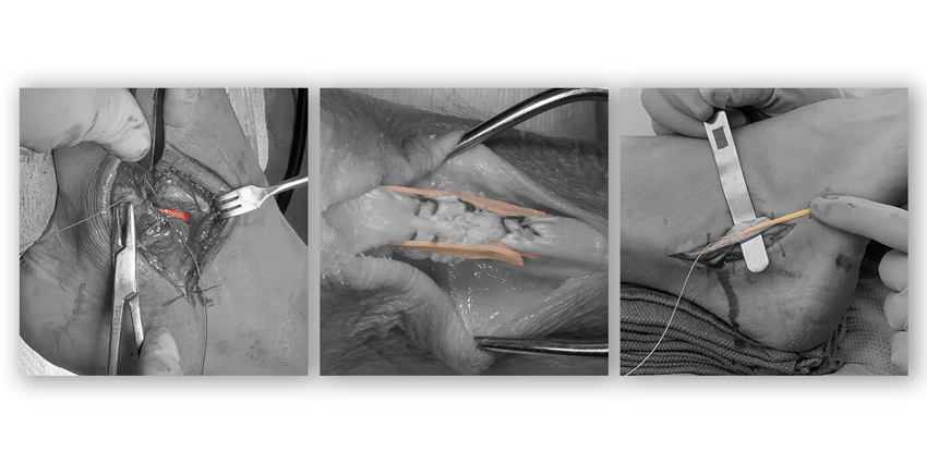 FDA Expands Indications for Novel Soft Tissue Repair