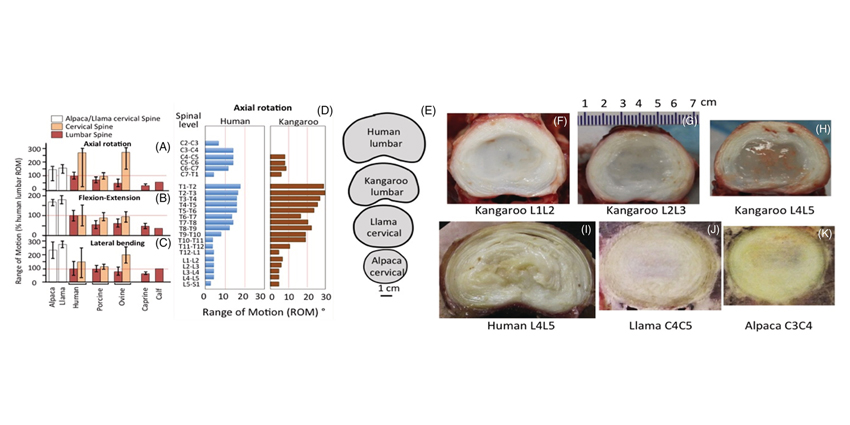 Using Artificial Intelligence to Unravel Degenerative Disc Disease