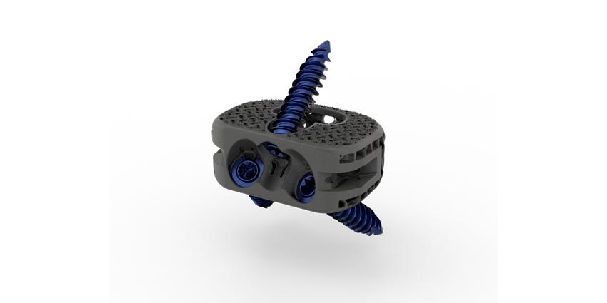 New Wave-Like ALIF Spinal Implant Launched
