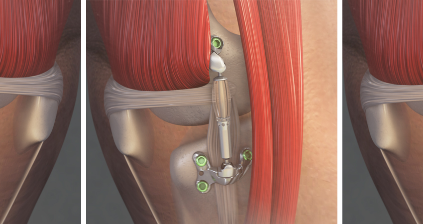 Implantable Knee Shock Absorbers: Two New Studies