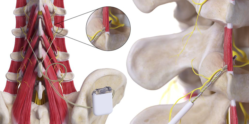 ISASS Issues NeuroStim Guidelines
