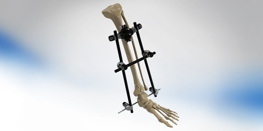Novel Sterile Kits for Orthopedic Trauma Launched
