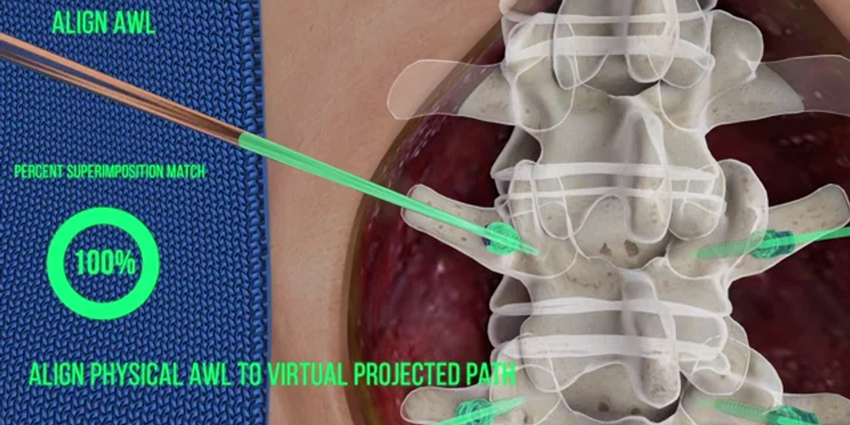 FDA Clears Novel Augmented Reality Spine System