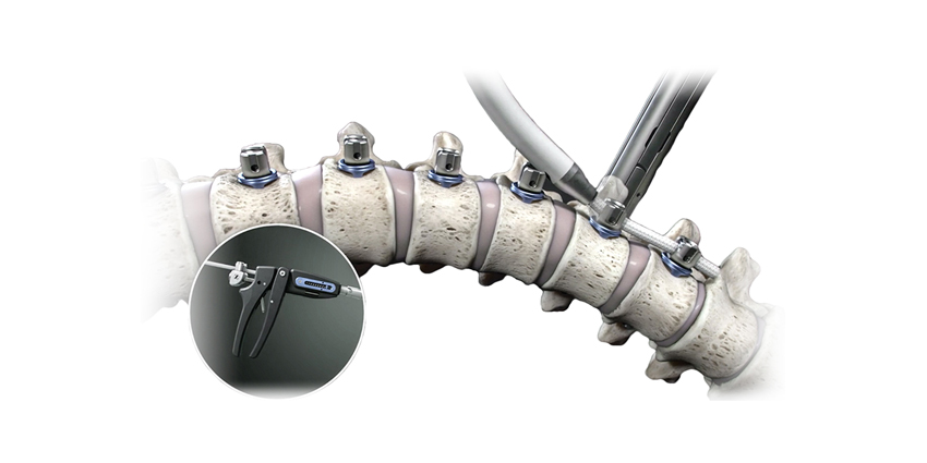 2000th Scoliosis Patient Treated With The Tether Non-Fusion System
