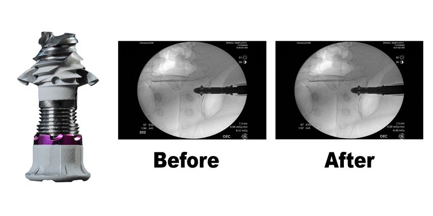 Novel SI Joint System 510(k) Cleared