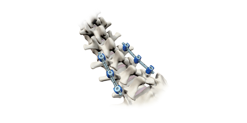FDA Clears ZimVie’s Implant for Use With BrainLab’s NAV System