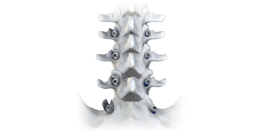 Novel, Low Profile Modular Posterior Fixation System Launched