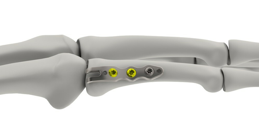 510(k) Clearance for Plating System Line Extension