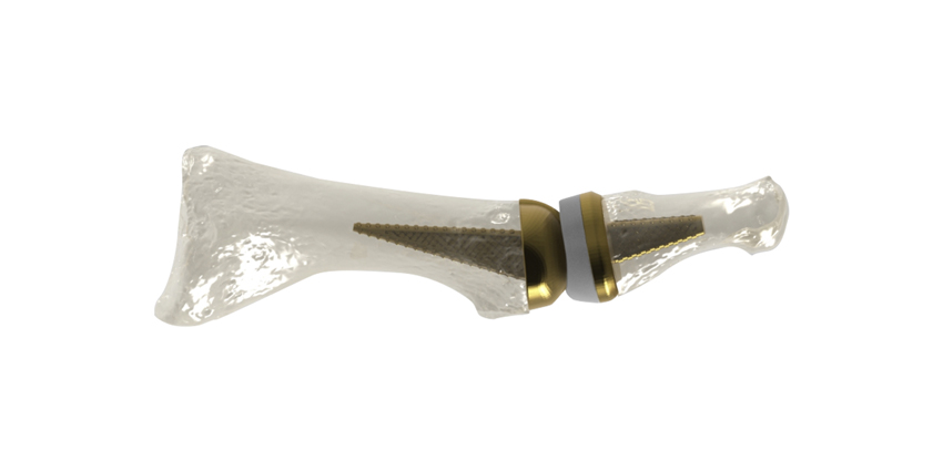 World’s First 3D Printed Toe Joint Replacement!