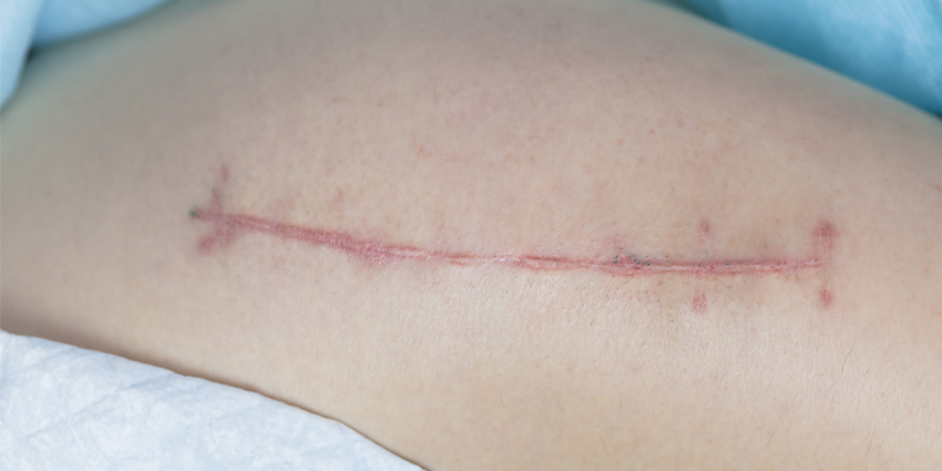 Journal of Arthroplasty Best Practices for TJA Wound Closure