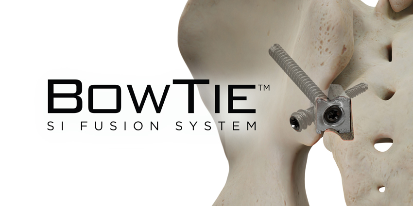510(k) Clearance for a ‘BowTie’ SI Joint Fixation Device