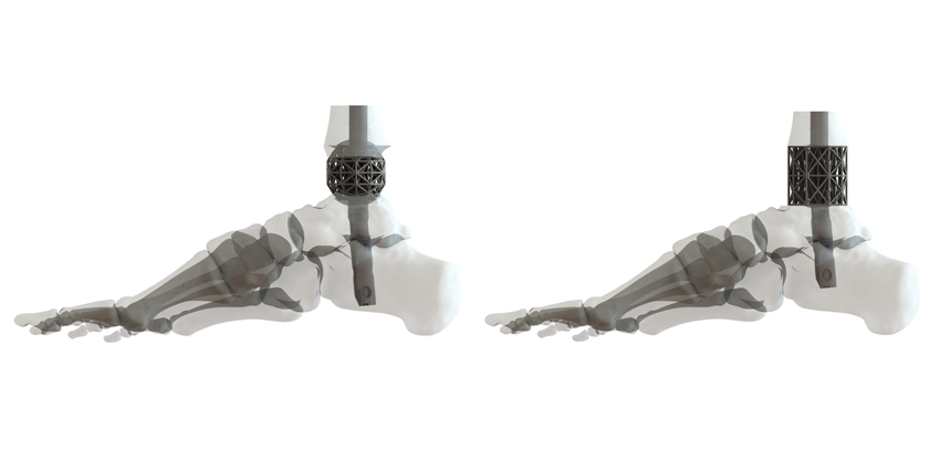 Big New: FDA Clears 3D Printed Ankle Fusion Implants
