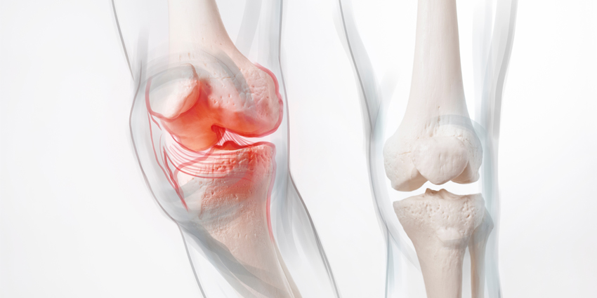 What Is ‘Success’ When Treating Knee PJI?