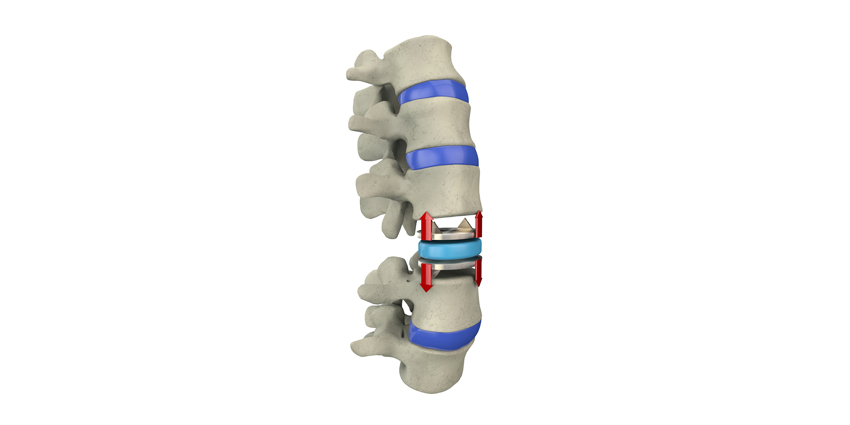 Landmark TDR Study: 2,141 Patients, 20-years