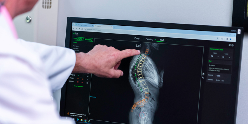 Beyond Pedicle Screw Placement: ATEC’s New EOS Insight