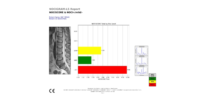 When a Standard Spine MRI Won’t Cut It