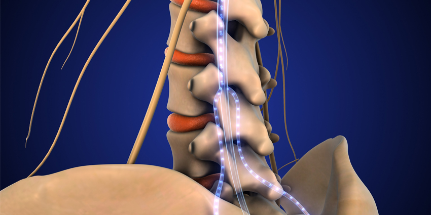 Spinal Cord Stimulation vs Conventional Management