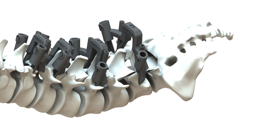 New Data Supports 3D Printed Pedicle Screw Guides