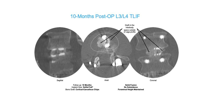 New Data for More Graft and Nerve Avoidance in TLIF