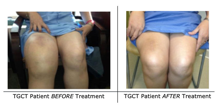 When Surgery Isn’t an Option, This Knee Tumor May Still Be Treated