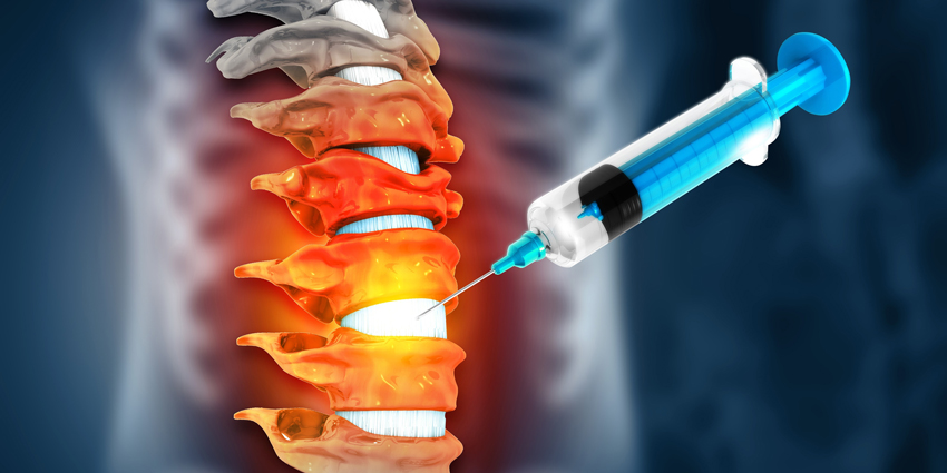 Injection to Relieve Radicular Leg Pain Tested in New Study